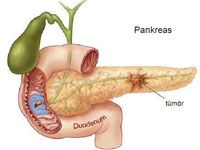 Pankreas Kanseri